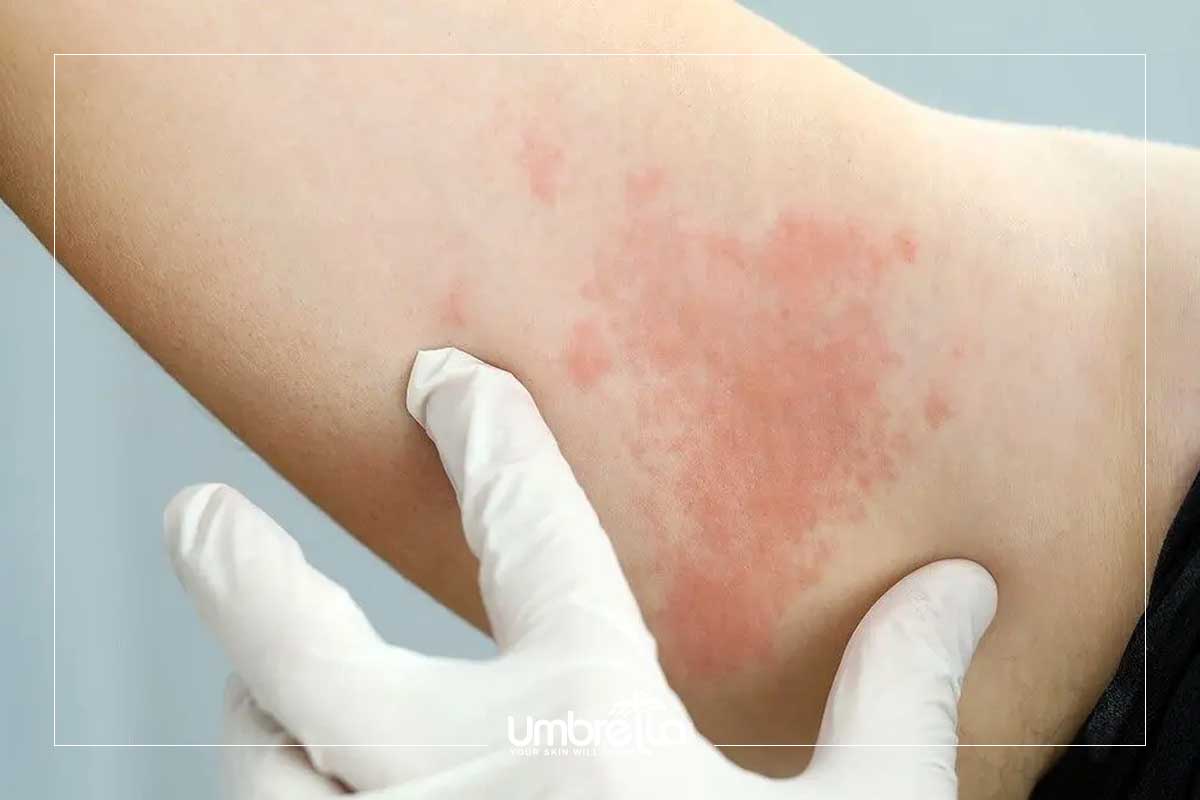 نکات مهم و عوارض احتمالی